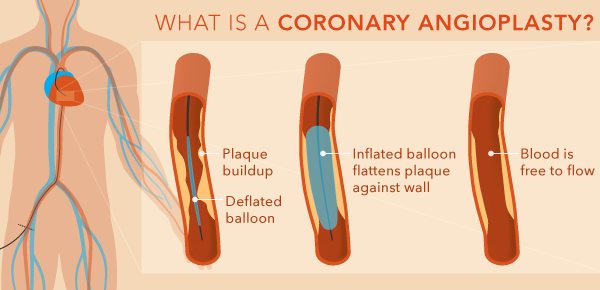 TRH-What-is-a-coronary-angioplasty Best Cardiologist in Pune