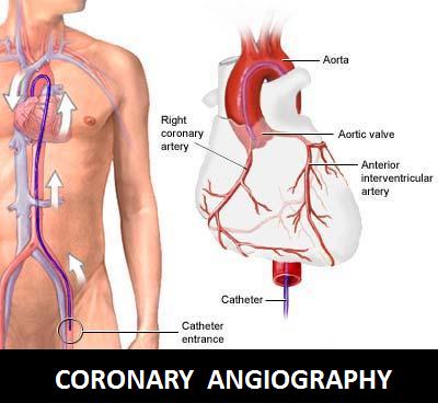 healthbase_coronary_angiography Best Cardiologist in Pune