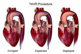 TAVR Procedures